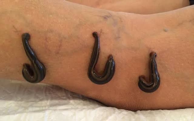 Leech therapy in vericose Veins